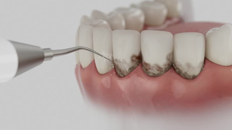Trusted Wisdom Tooth Removal service in San Antonio, FL - Dentist Open Now
